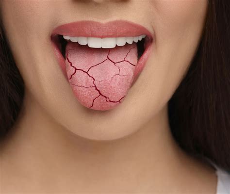 Immagine: bocca secca cause e rimedi