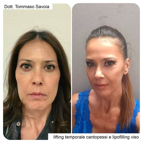 prima e dopo lipofilling seno