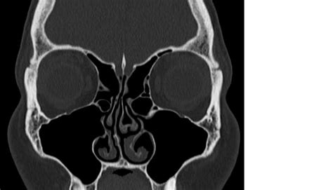 immagine radiografia TC massiccio facciale
