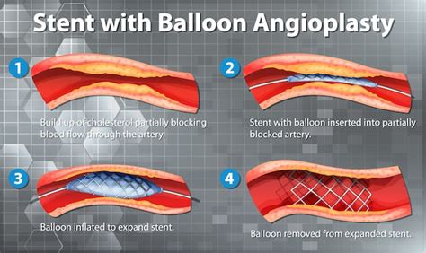 diagramma palloncino sinuplasty auge