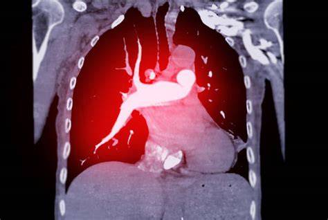 CTPA_epid XX (CTPA per EP nei COVID-19)