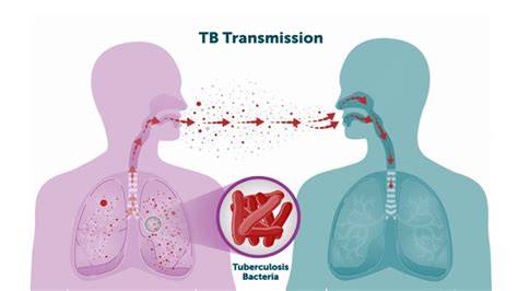 mappa globale TB e distribuzione End TB