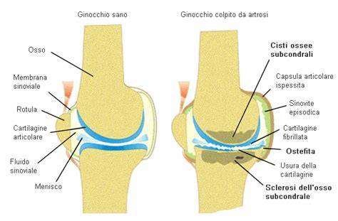 geodi e cisti ossee, artrosi e patologie ossee
