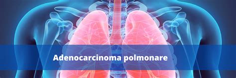 pazienti giovani adenocarcinoma polmonare esperienze
