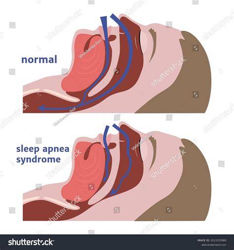 Complessa sleep apnea: CPAP adaptation diagram