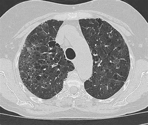 immagine radiologica alveolare e vetro smerigliato