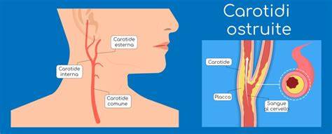 mappa delle arterie carotidi e TSA