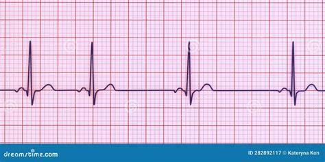 iconografía de un ECG con arritmia sinusal