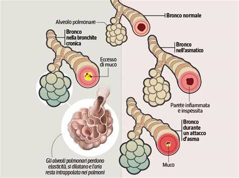 Diagramma differenze asma vs bronchite (breve confronto)