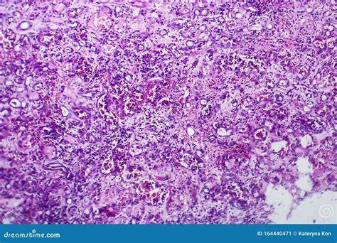 immagine diagnostica nefrite interstiziale