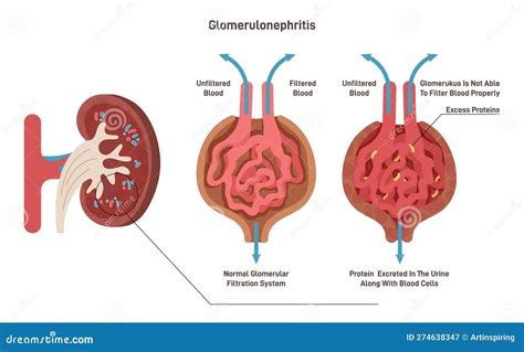 flussio di pathogenesis nefriti interstiziali