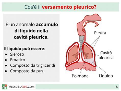 grafico trasudati vs essudati nel versamento pleurico