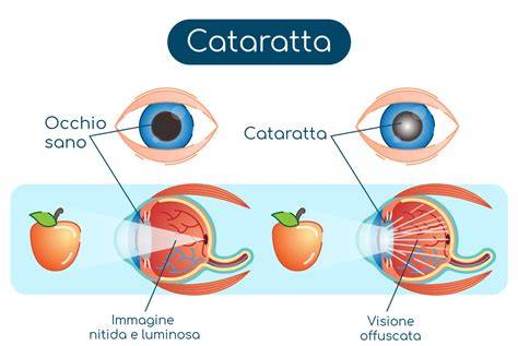 infografica sulle tecniche di estrazione della cataratta nel XIX secolo