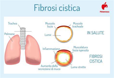 schema dinamiche relazione fibrosi cistica