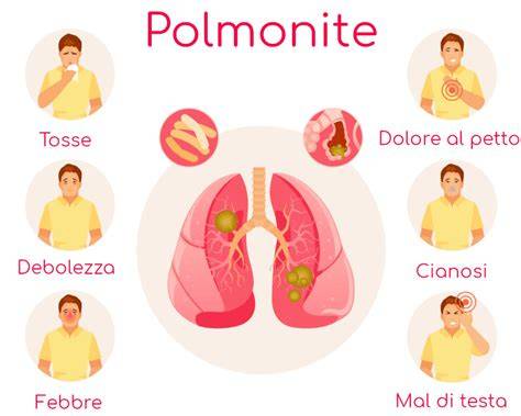 grafico polmoniti e sintomi comuni