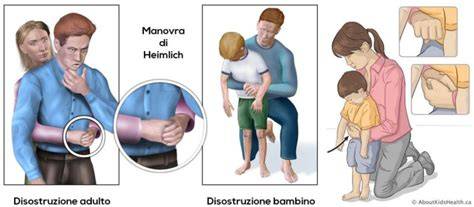 foto dimostrativa manovre Heimlich bambino