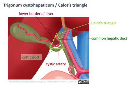 mappa anatomica triangolo di Calot