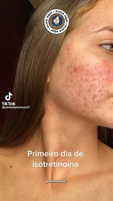 ischio grafico sull’Isotretinoina e acne