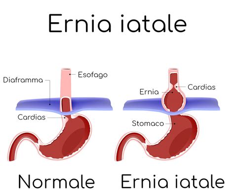 Immagine: Flusso diagnostico per dispnea legata all’ernia iatale