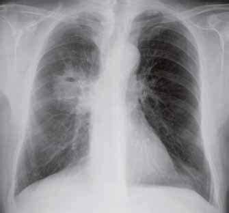 Immagini radiografiche CF polmonare