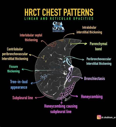 HRCT patterns evaluation multidiap