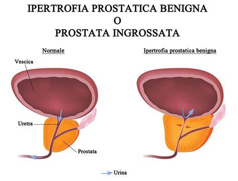 panorama della prostata e uretra