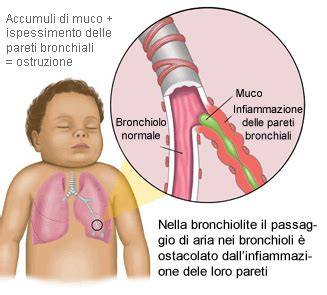 grafico incidenza stagionale bronchiolite