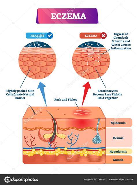 schema pelle irritata eczema rash
