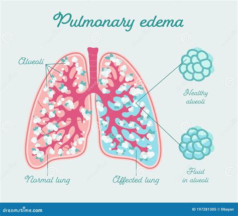 Illustrazione di edema polmonare e funzione renale