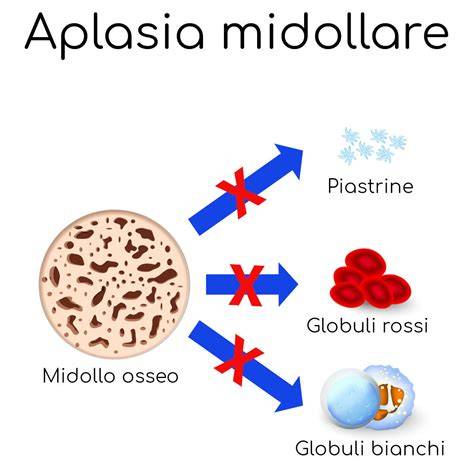 Aplasia midollare infografica: flusso diagnostico