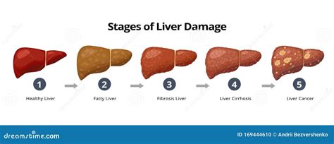 fibrosis progression infographic