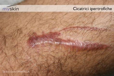 Confronto tra cheloide e cicatrice ipertrofica
