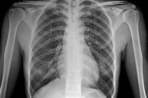 Ombre ilari radiografia torace concetto