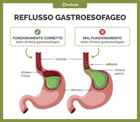 diagramma reflusso gastrico e tosse
