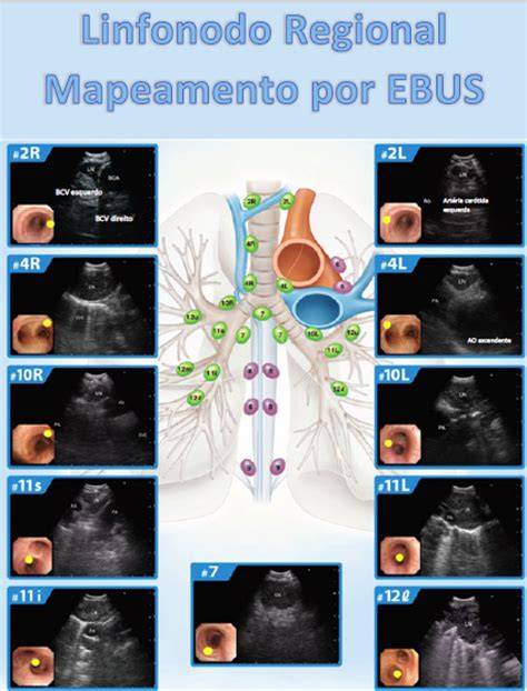 EBUS e accesso ai linfonodi mediastinali infografica